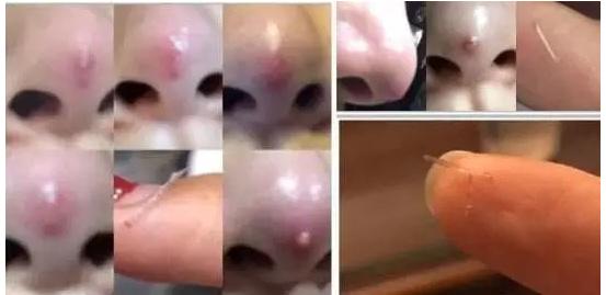 线雕的十大骗局,揭秘线雕埋线你不知道的内幕