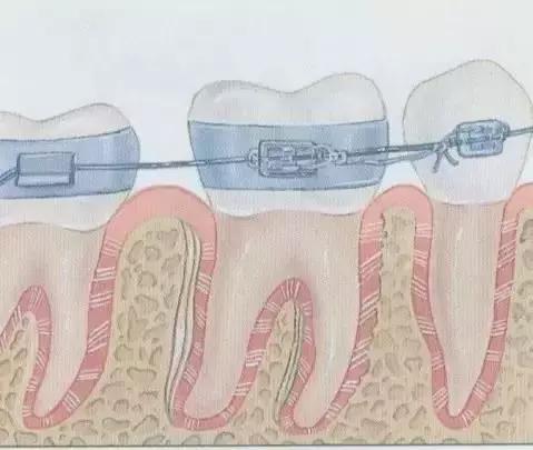牙套上的丑钢丝,牙套上钢丝有一点锈