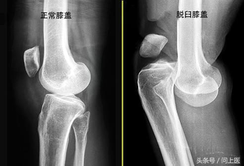 高中生膝盖疼痛的原因和解决方法,爬楼梯膝盖疼痛的原因和解决方法
