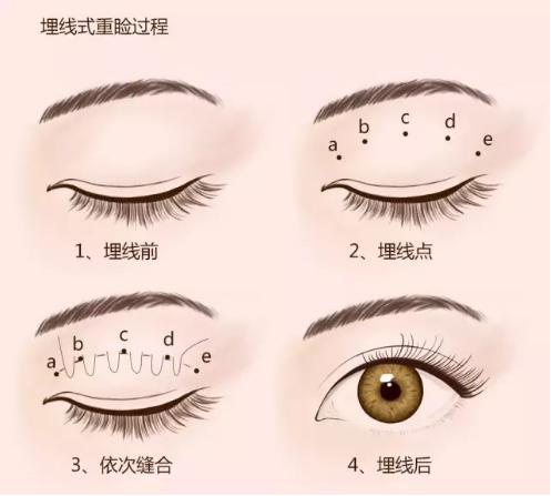 线雕的十大骗局,揭秘线雕埋线你不知道的内幕