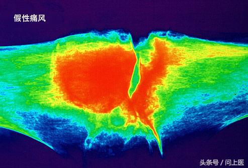高中生膝盖疼痛的原因和解决方法,爬楼梯膝盖疼痛的原因和解决方法