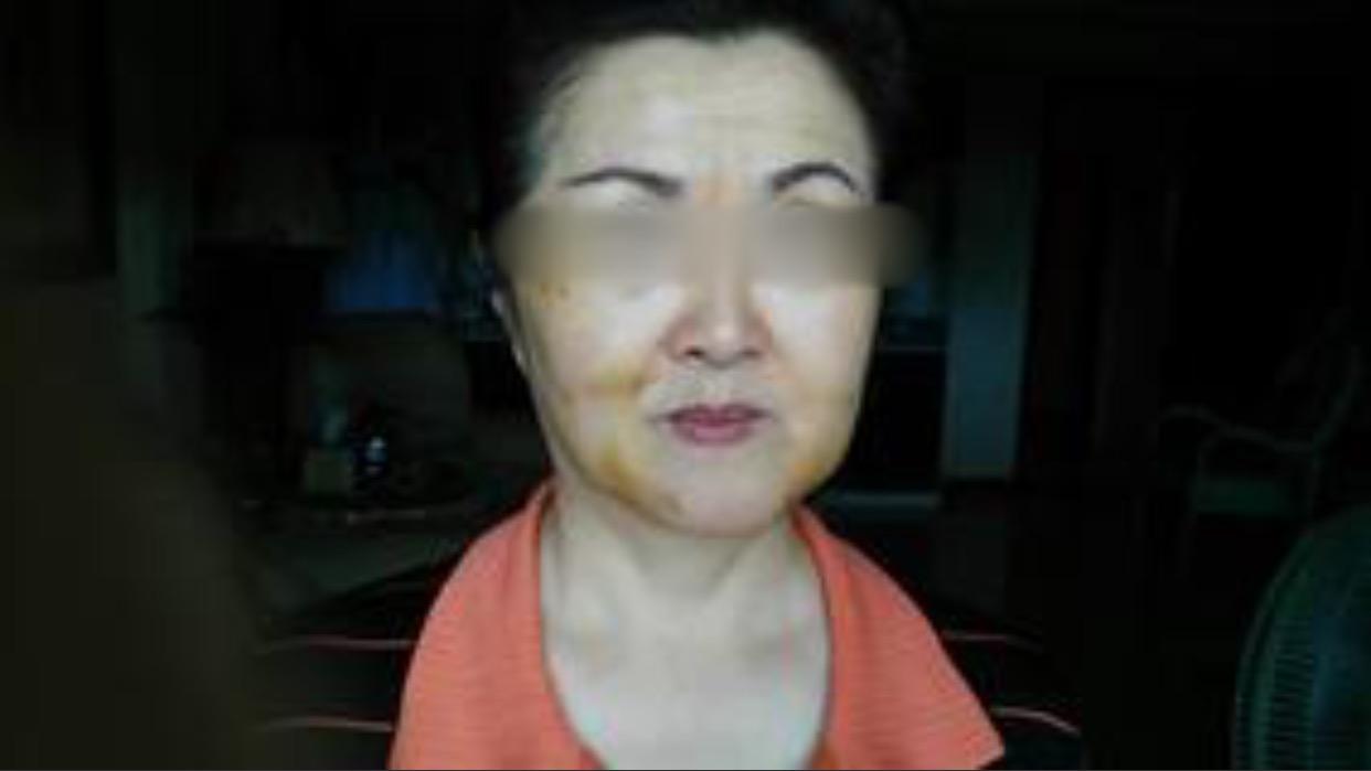 线雕的十大骗局,揭秘线雕埋线你不知道的内幕