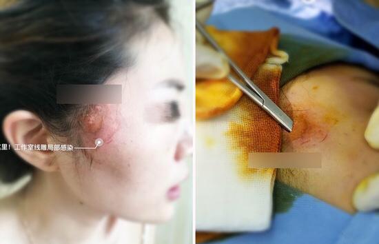 线雕的十大骗局,揭秘线雕埋线你不知道的内幕