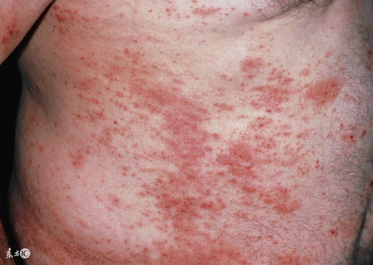 宝宝身上长湿疹可以用什么泡澡,宝宝湿疹饮食关注事项和禁忌