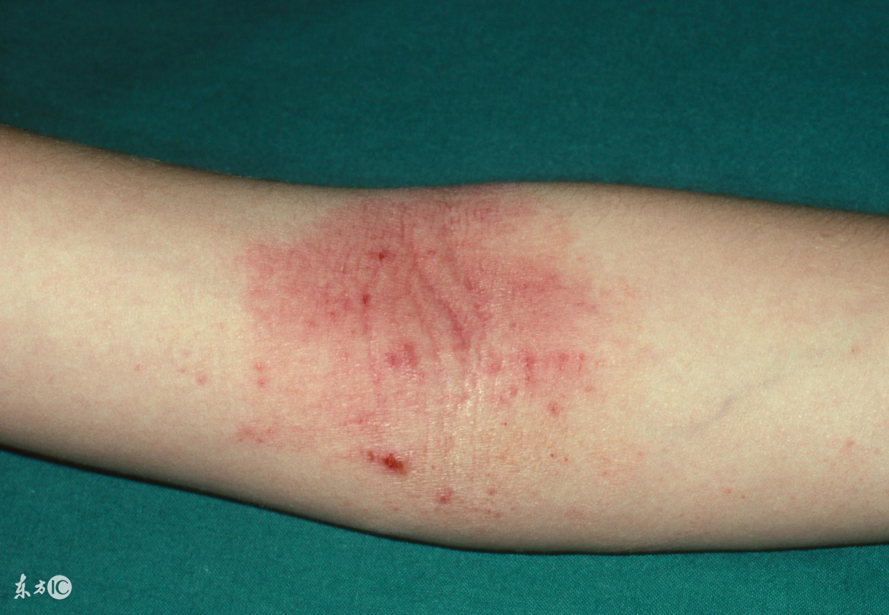 宝宝身上长湿疹可以用什么泡澡,宝宝湿疹饮食关注事项和禁忌