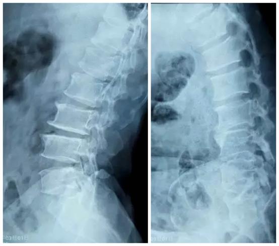 椎间盘突出症椎间孔镜术的概述,椎间孔镜治疗颈椎间盘突出过程