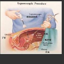 巧克力囊肿手术后怀孕几率多大,得了巧克力卵巢囊肿竟然怀孕了