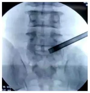 椎间盘突出症椎间孔镜术的概述,椎间孔镜治疗颈椎间盘突出过程