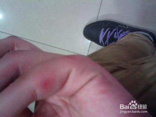 恶补：用香蕉皮预防冻疮，08年冰灾我就该知道的事！