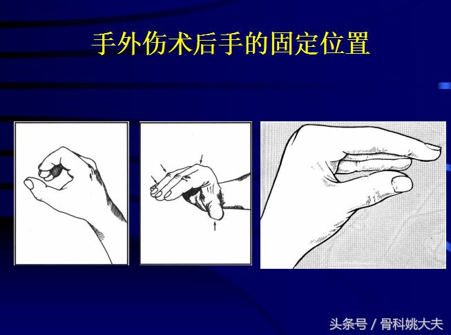 手肌腱损伤图片,手外伤神经肌腱损伤怎么定残