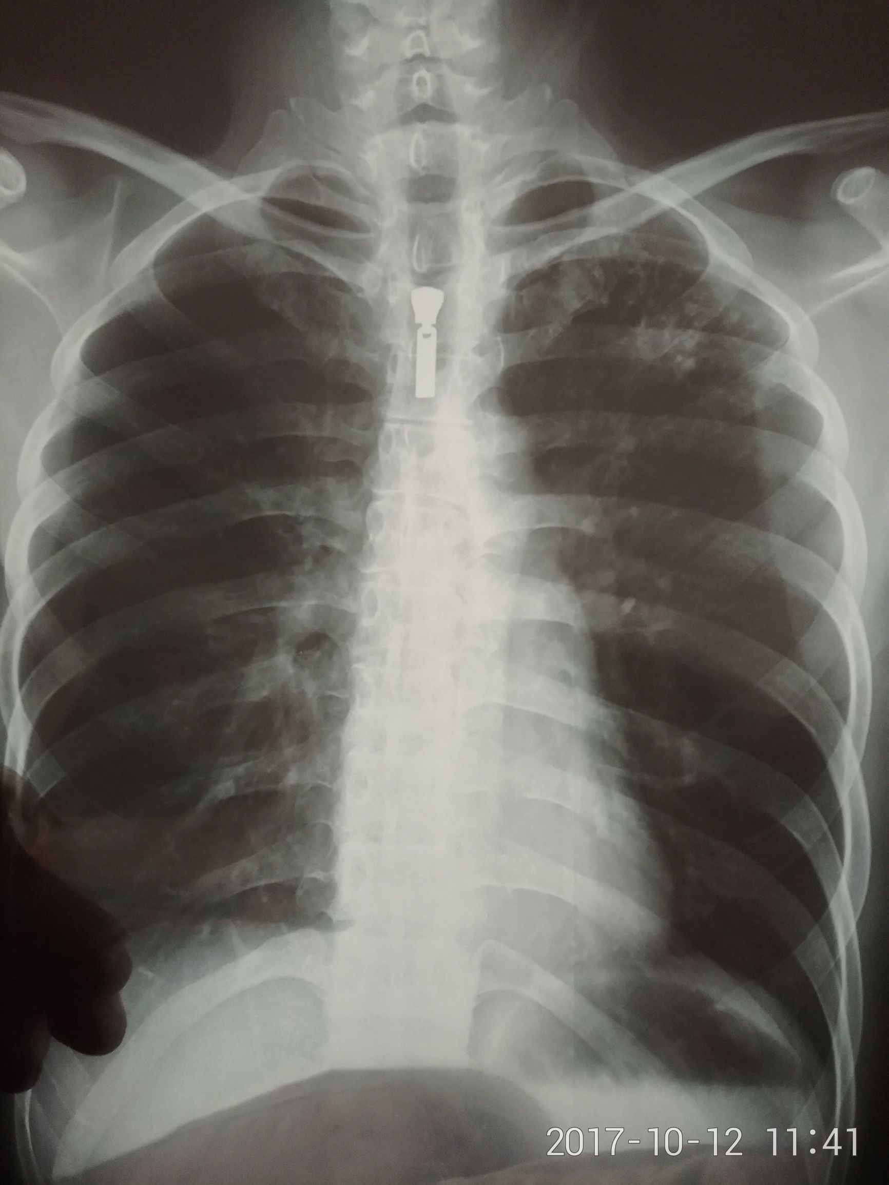 抗核日记：一个肺结核患者的治疗过程㈠