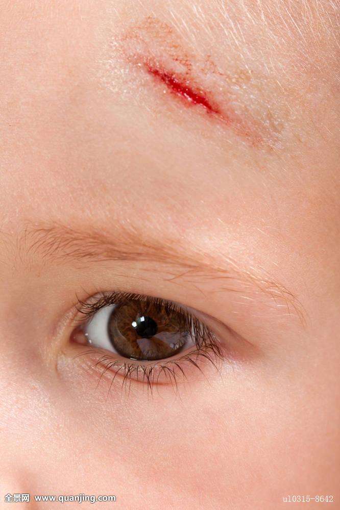 宝宝抓破皮流脓怎么处理,宝宝手被蹭破皮了要不要打碎伤风