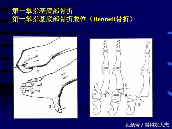 手肌腱损伤图片,手外伤神经肌腱损伤怎么定残