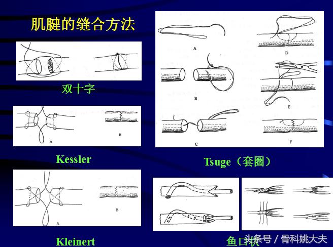 手肌腱损伤图片,手外伤神经肌腱损伤怎么定残