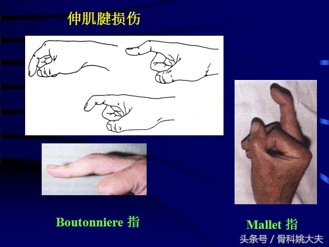 手肌腱损伤图片,手外伤神经肌腱损伤怎么定残