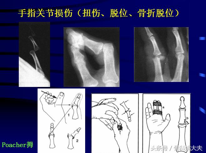 手肌腱损伤图片,手外伤神经肌腱损伤怎么定残