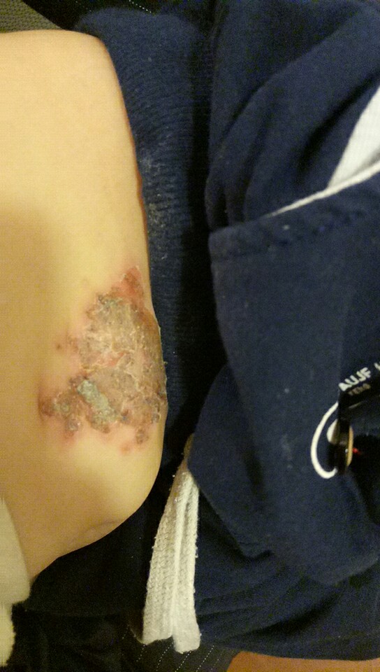 宝宝抓破皮流脓怎么处理,宝宝手被蹭破皮了要不要打碎伤风