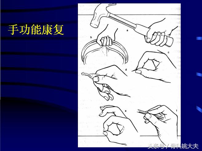 手肌腱损伤图片,手外伤神经肌腱损伤怎么定残