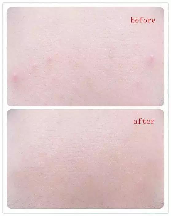 痘痘不长出来也不消怎么办,脸上的痘印持久不消