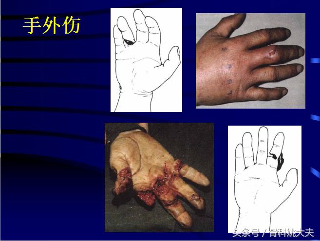 手肌腱损伤图片,手外伤神经肌腱损伤怎么定残