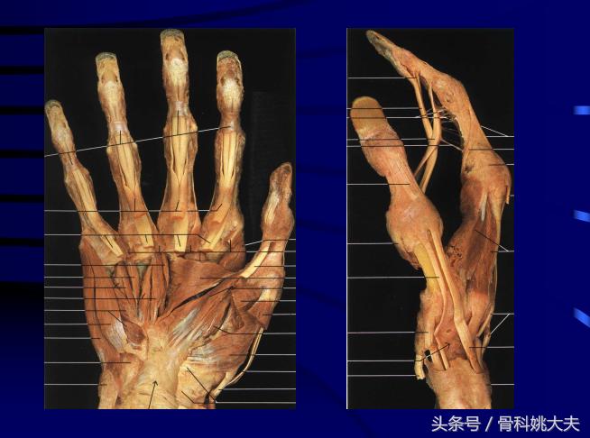 手肌腱损伤图片,手外伤神经肌腱损伤怎么定残