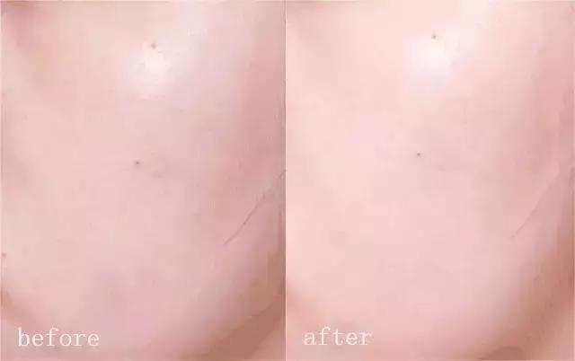 痘痘不长出来也不消怎么办,脸上的痘印持久不消