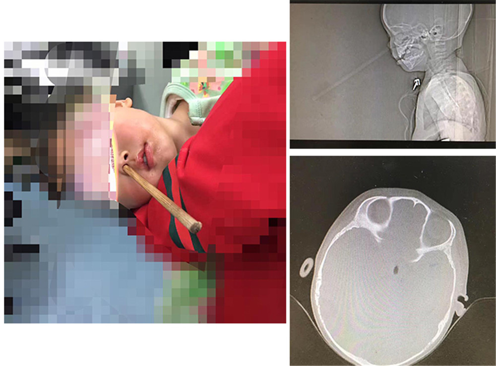 小孩吃饭不小心把筷子插到喉咙,孩子吃饭拿筷子插入鼻子