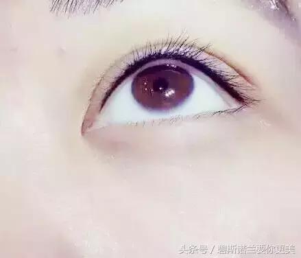 做了美瞳线双眼皮不见了,美瞳线做完1-7天肿胀的对比图