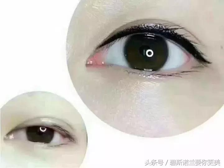 做了美瞳线双眼皮不见了,美瞳线做完1-7天肿胀的对比图