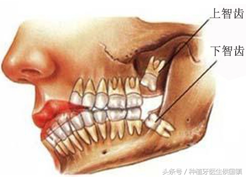 阻生齿微创拔除与复杂智齿拔除,拔除上颌智齿可以下午拔除吗