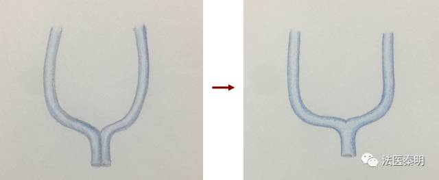 女人有两个子宫怎么办,有两个子宫怎么治疗