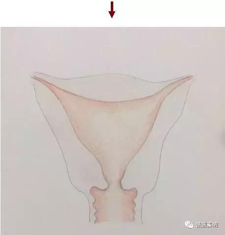 女人有两个子宫怎么办,有两个子宫怎么治疗