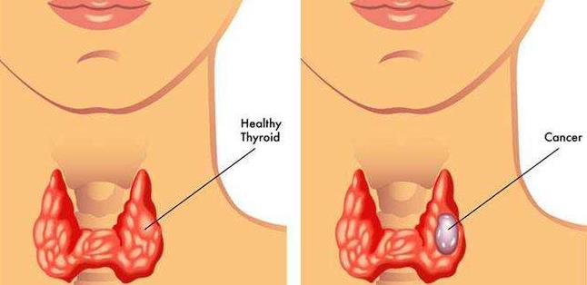 快被癌症家族扫地出门的甲状腺癌：高发却温和10年存活率可达90%