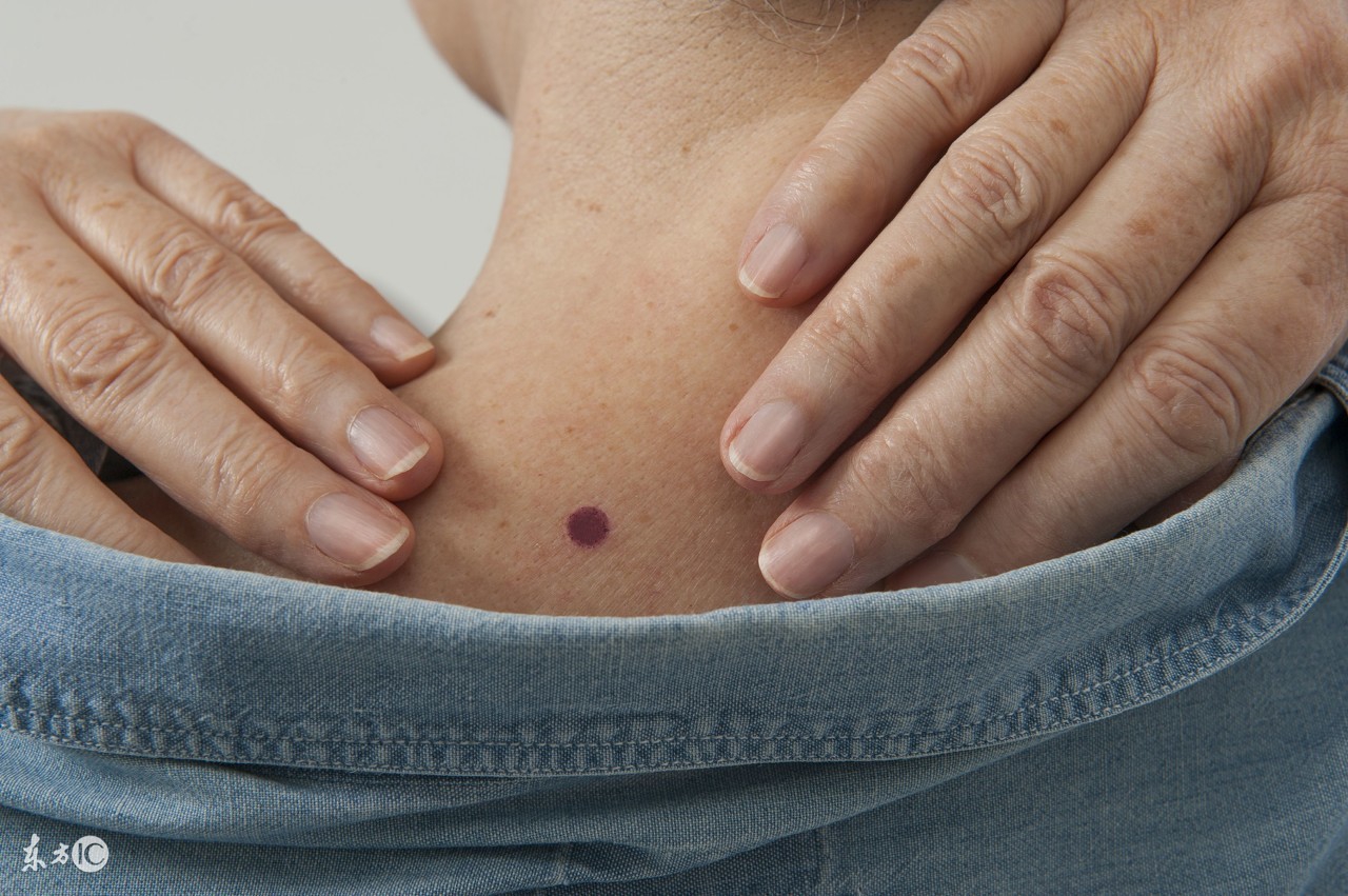 蜘蛛痣会突出表面么,出血类疾病会导致蜘蛛痣吗