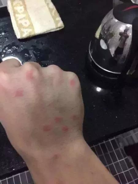 23岁女孩得红疹,女孩身体起红疹水泡