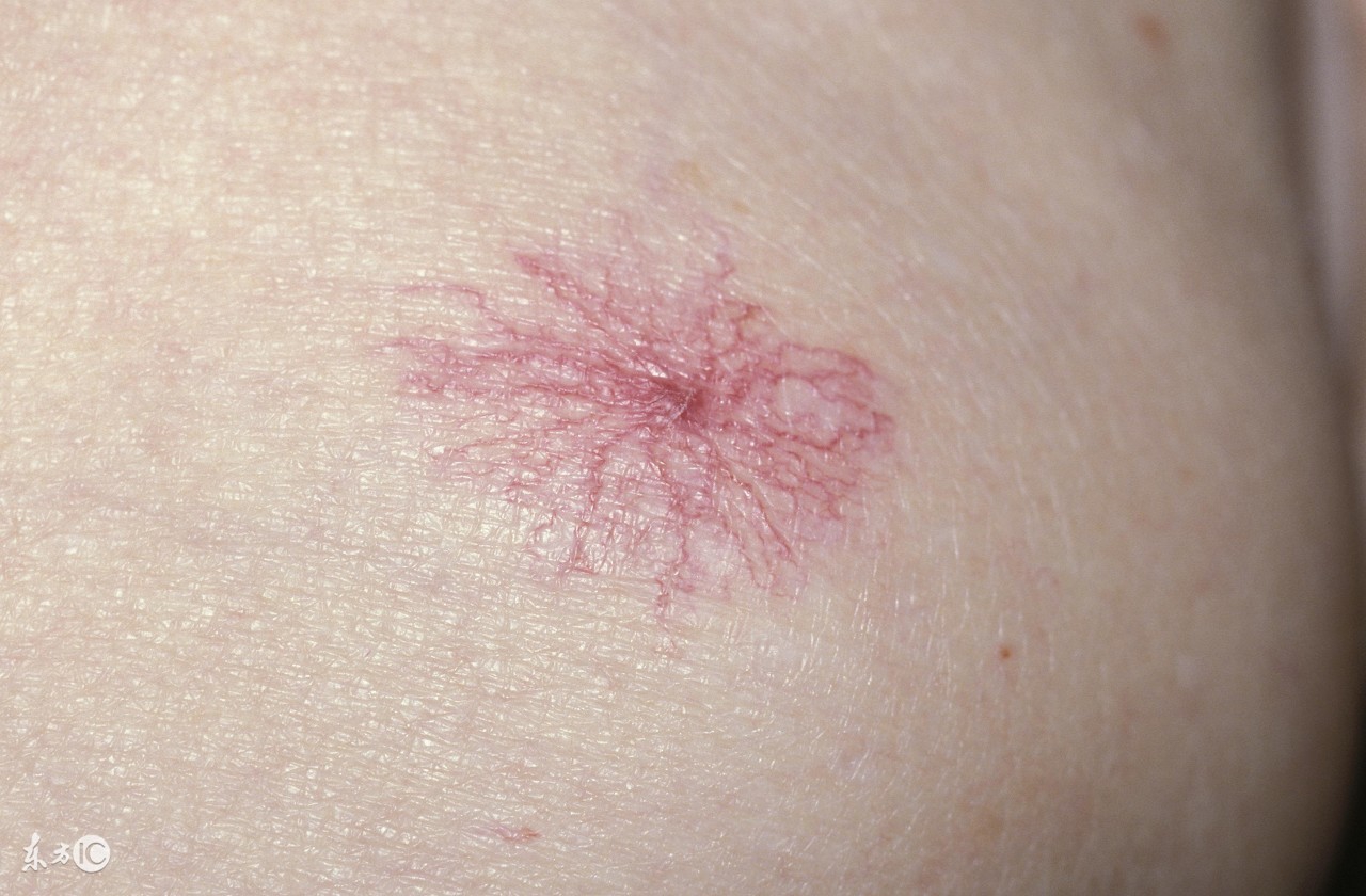 蜘蛛痣会突出表面么,出血类疾病会导致蜘蛛痣吗