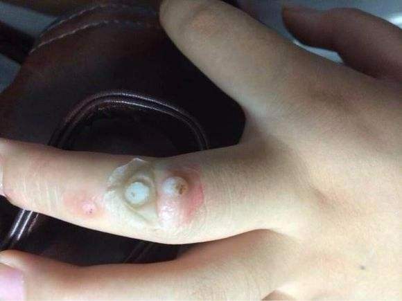 洗澡洗一身瘊子,后背长瘊子和搓澡有关系吗