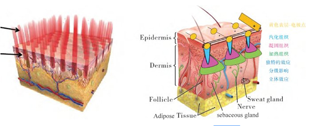 激光对皮肤正常结构的影响