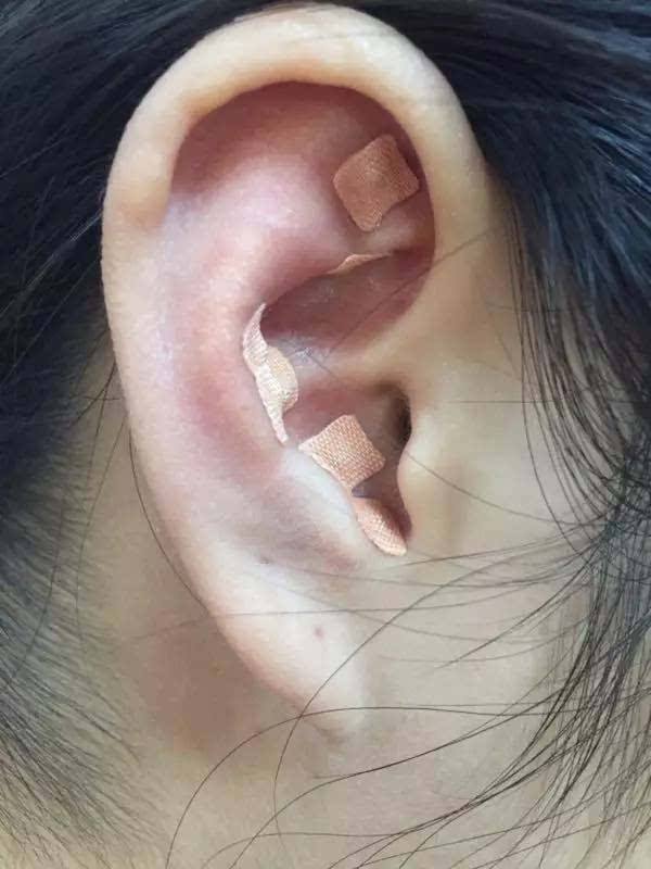 耳穴埋籽的正确方法视频,耳穴埋籽穴位教程