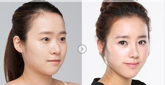 隆鼻的介绍,隆鼻材料大揭秘哪种才更适合你