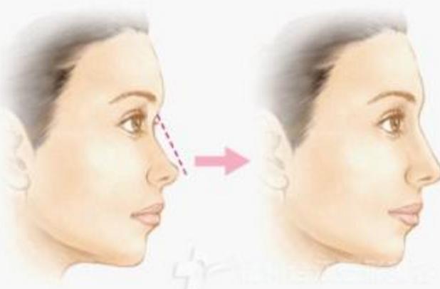 隆鼻的介绍,隆鼻材料大揭秘哪种才更适合你