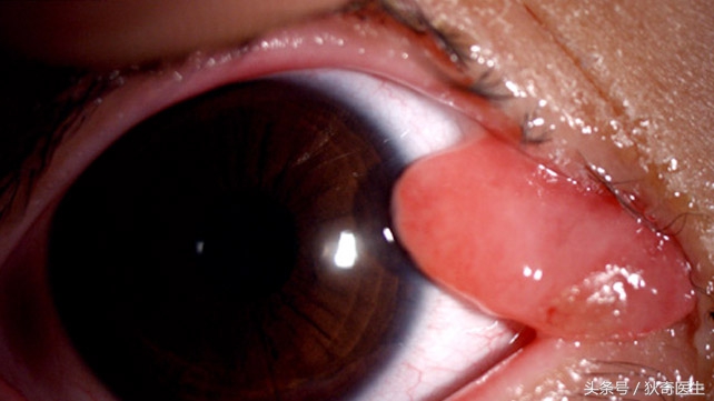 血管瘤系列科普之四，肉芽肿性血管瘤