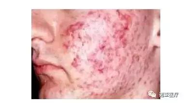 肥胖导致内分泌失调月经紊乱,月经不规律多毛怎么办