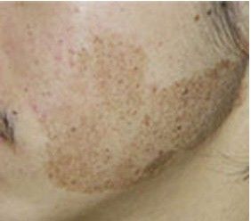 专业激光祛雀斑胎记,激光祛胎记斑痣