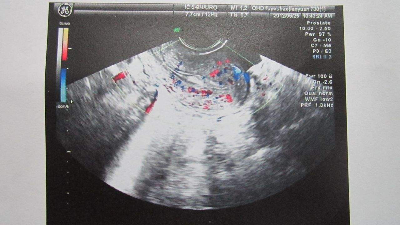 B超和阴超有什么区别,b超和阴超的区别动画