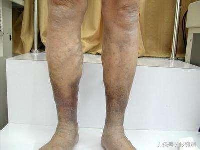 男人腿肿胀是什么病的前兆,下肢发凉久坐发紫是什么原因
