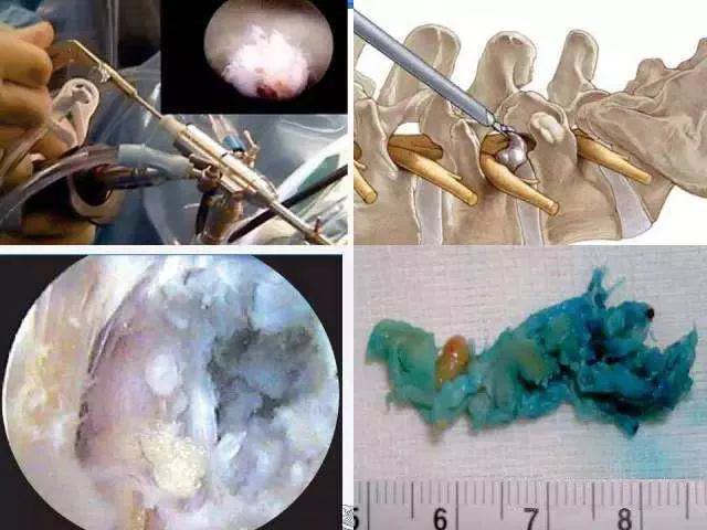 腰椎间盘突出症讲究长期缓解，无任何方法可保证不复发！