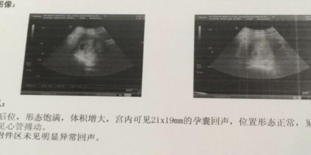 孕9个月胎停引产,宝妈胎停被引产