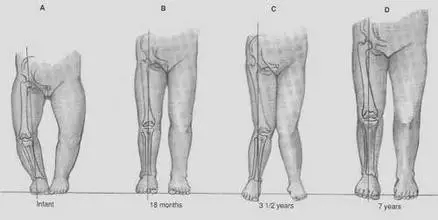 宝宝突然走路不稳o型腿,走路走不稳的宝宝
