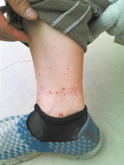 你的脚脖子出现过这种小红点吗？可知道它们是哪里来的